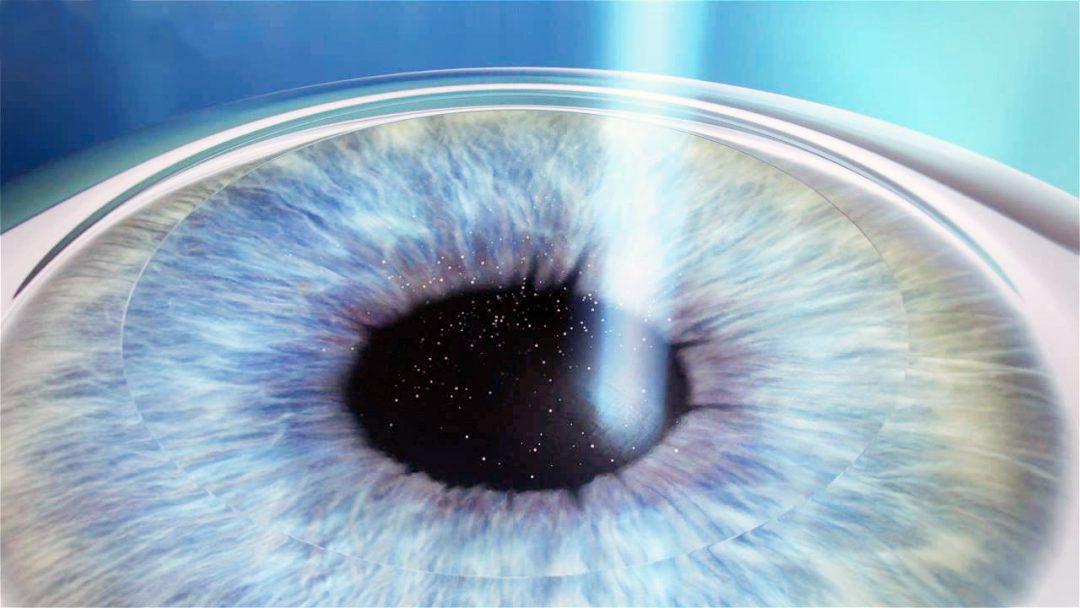 Chirurgie de la cataracte Ophtalmologie Dr Lafontaine